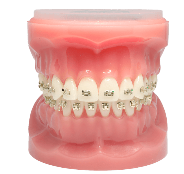 Benefits of Iconix braces